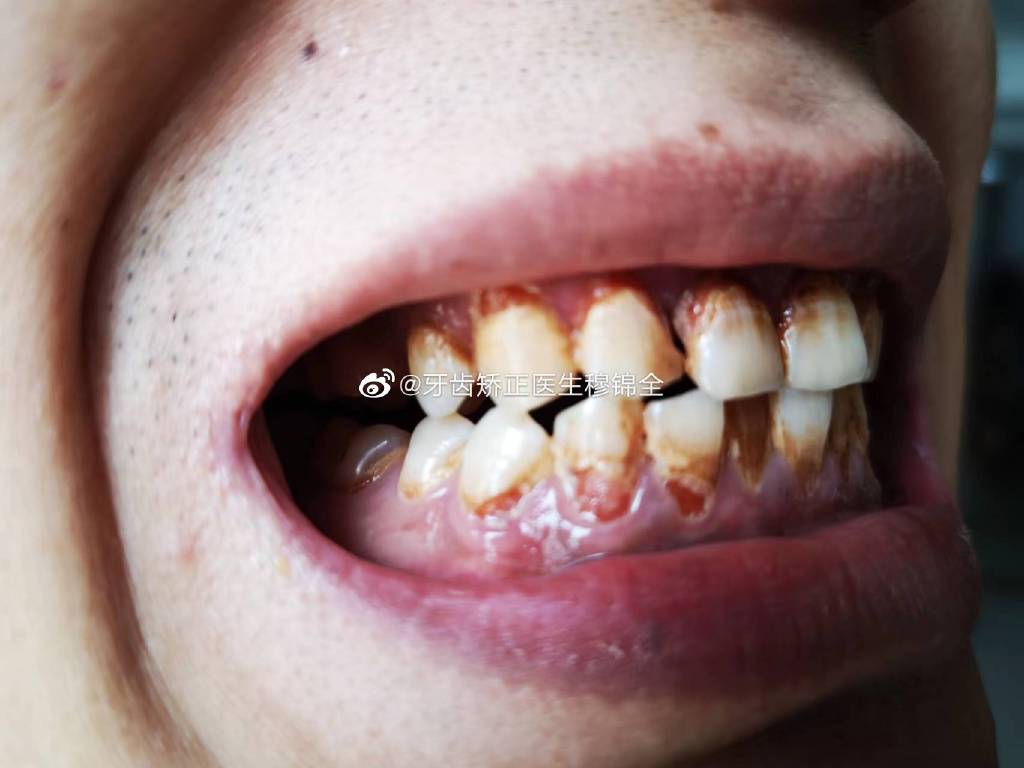 家族遗传骨性龅牙，咬合不正常，拔8颗牙正畸后从超级严重龅牙妹，变成了普通龅牙妹！ - 知乎
