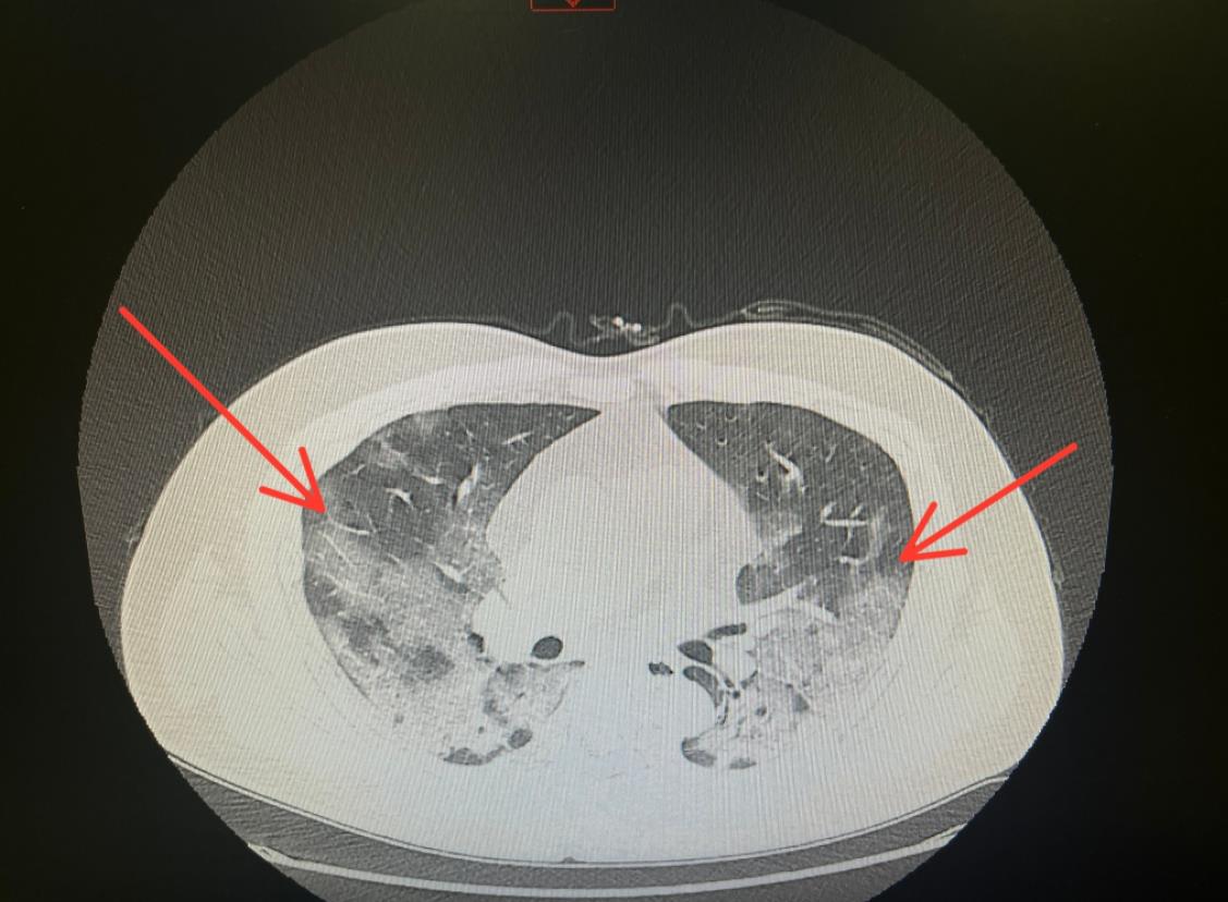 轻松读懂肺炎实变的影像学征象│以影识病_肺炎_影像学征象_医脉通